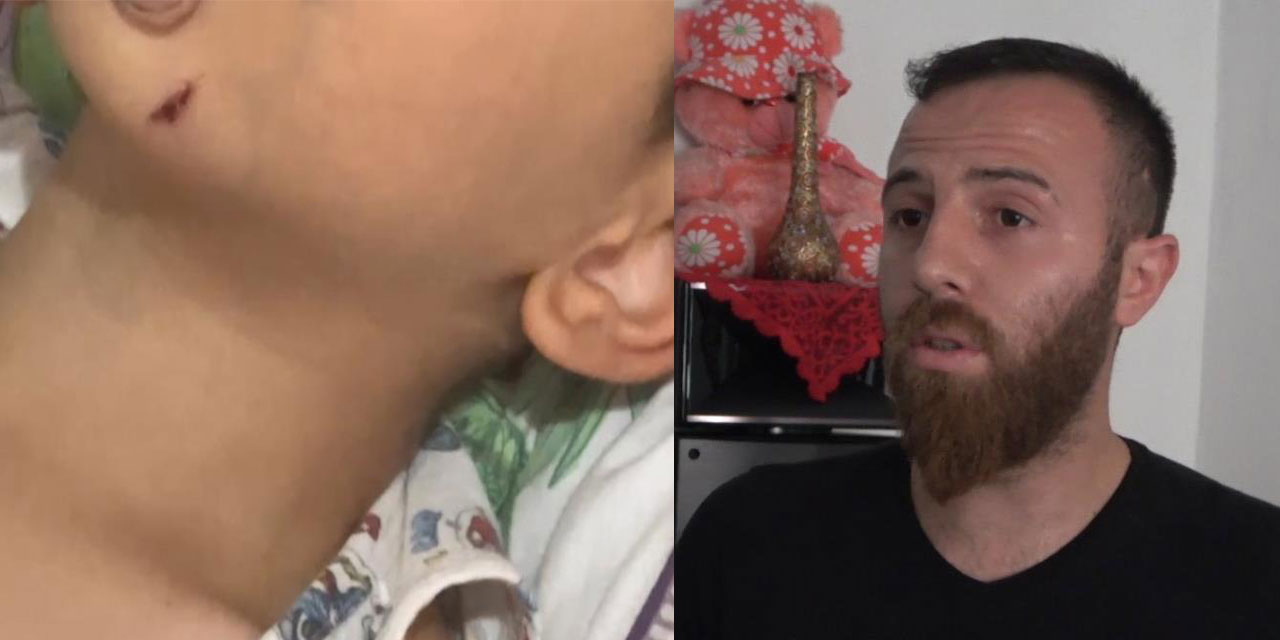 Rize’de 5 yaşındaki çocuk, sokak köpeğinin saldırısına uğradı