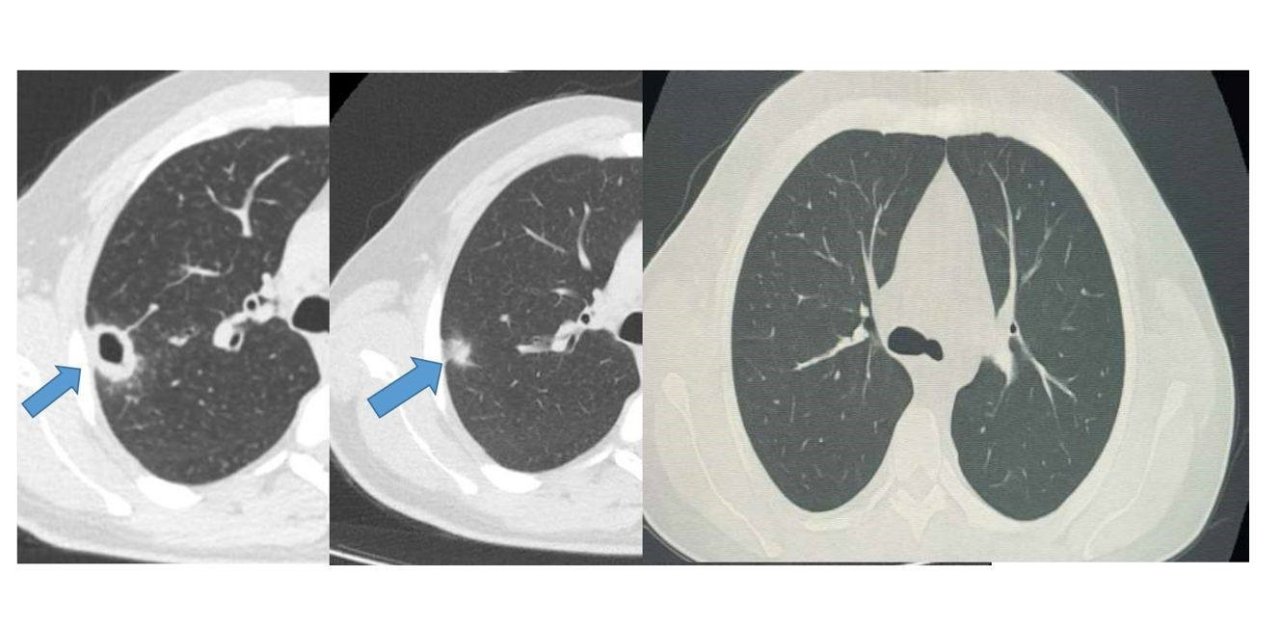 Bayburt’ta 50 yaşındaki hasta erken tanıyla sağlığına kavuştu