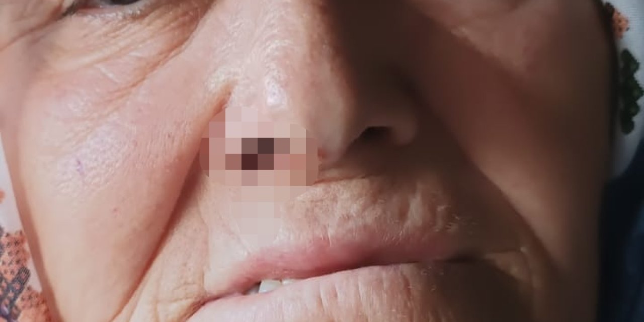 'Goruk' Fındık Tartışmasında 73 Yaşındaki Kadını Darbettiler; 3 Gözaltı