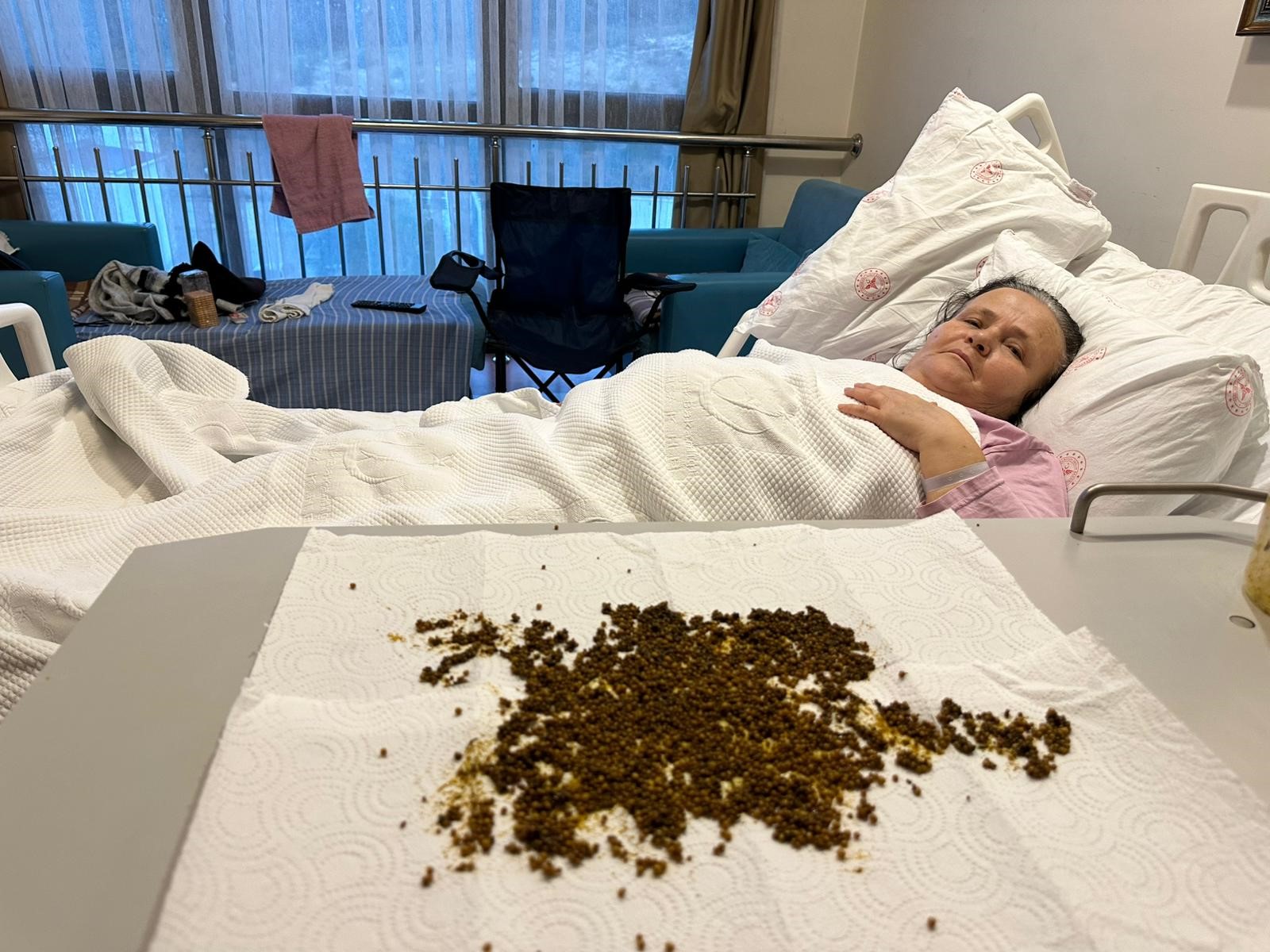 Hastadan çıkan taşları sayamadılar