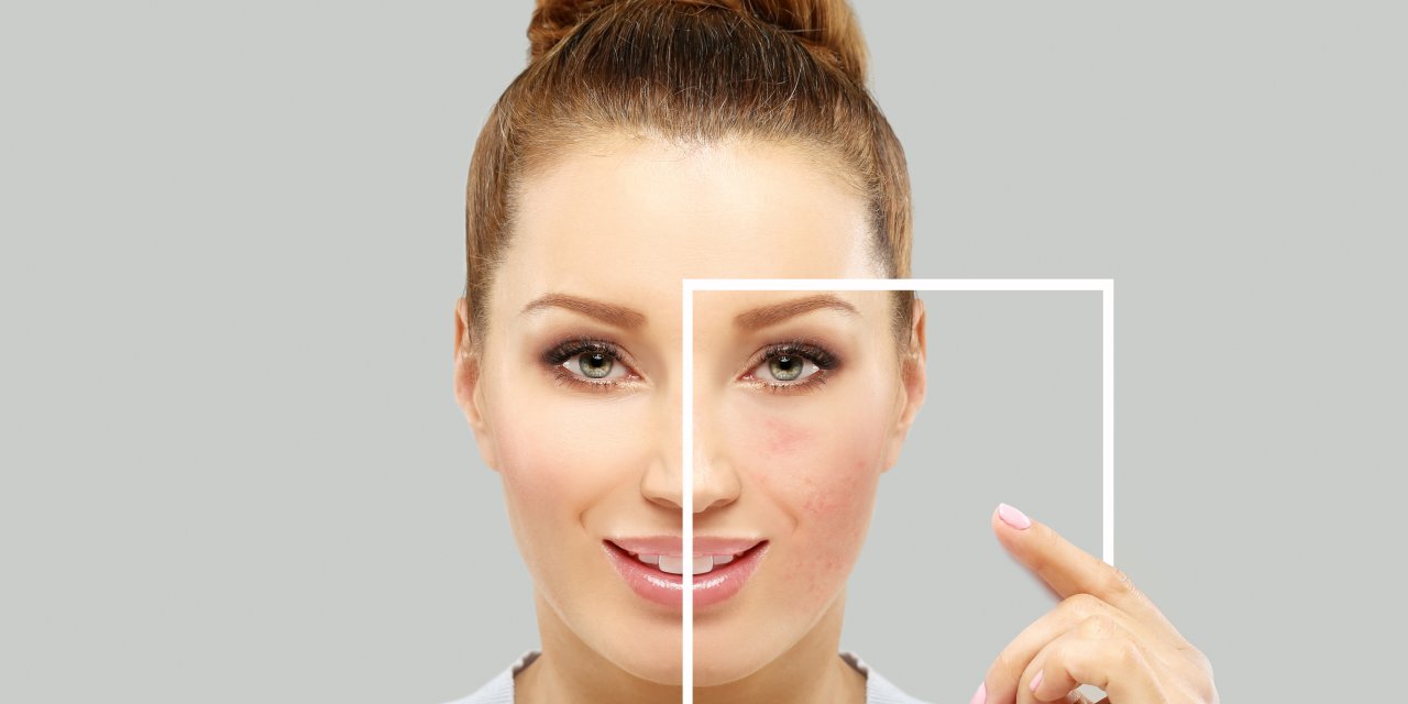 "Rosacea, Kişiye Özel Uygulanacak Doğru Tedavilerle Kontrol Altına Alınabilir"