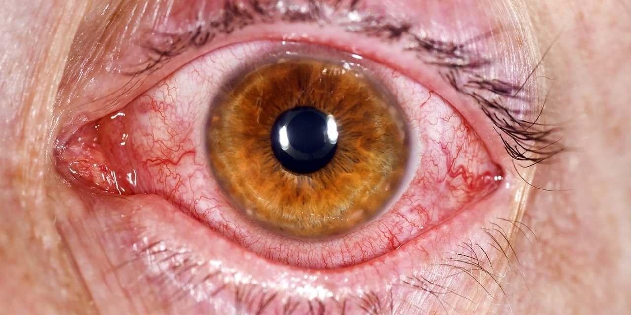 Pakistan’da Kırmızı Göz Salgını Nedeniyle Okullar Tatil Edildi