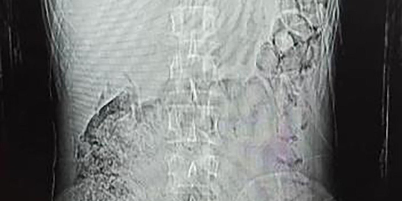 İranlı Şüphelinin Mide Ve Bağırsağından Uyuşturucu Çıktı