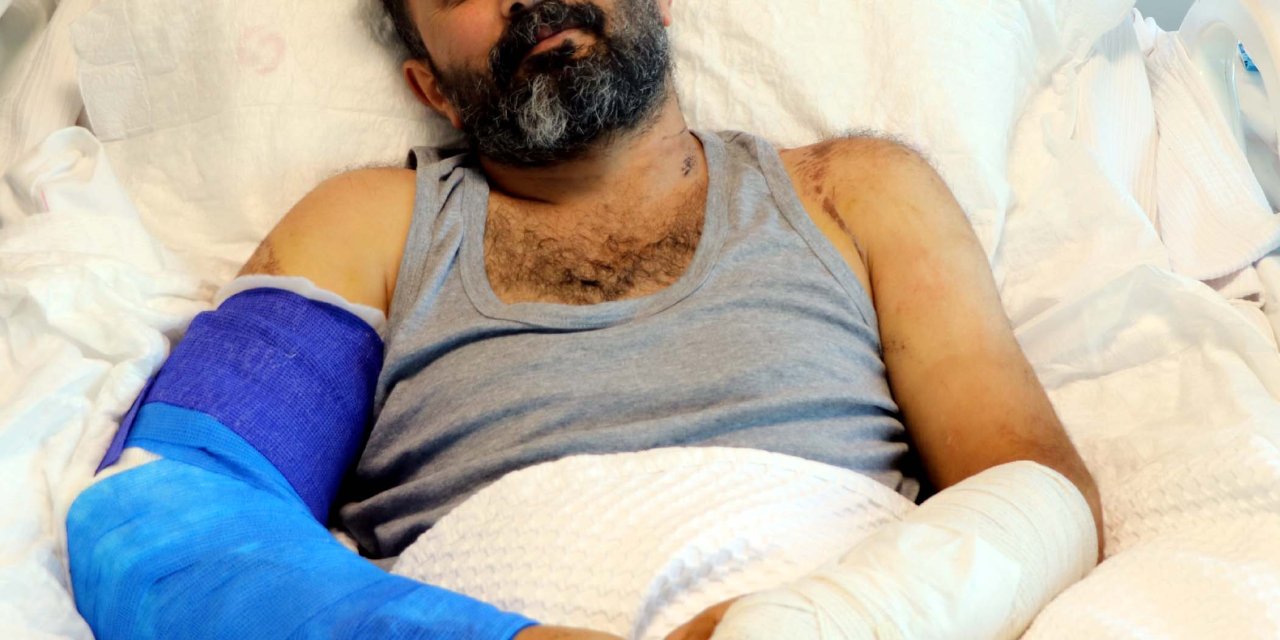 İş Kazasında Makineye Sıkışan Kolları Mikrocerrahi İle Kesilmekten Kurtarıldı