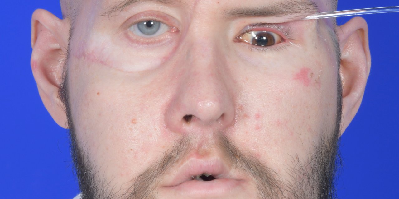 Abd’de Bir Hastaya ‘Tam Göz’ Nakli Yapıldı