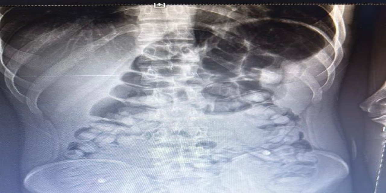 Yolcunun Midesinden 1 Kilo 134 Gram Afyon Sakızı Çıktı