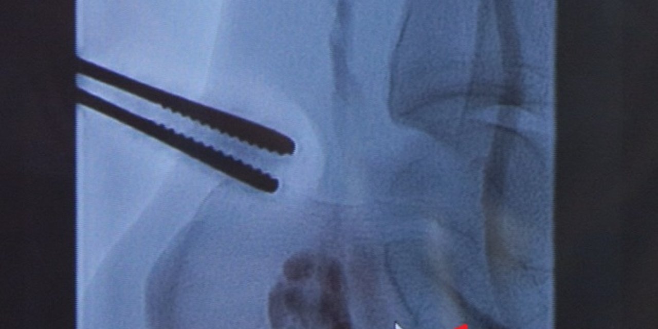 "Kesilmek Zorunda" Denen Bacağını Yüzyılın Cerrahı Kurtardı