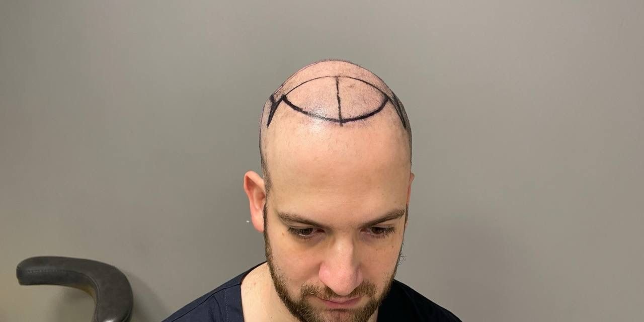 Amerikalı Hastalar Saç Ektirmek İçin Türkiye’ye Geliyor; Talep Yüzde 150 Arttı