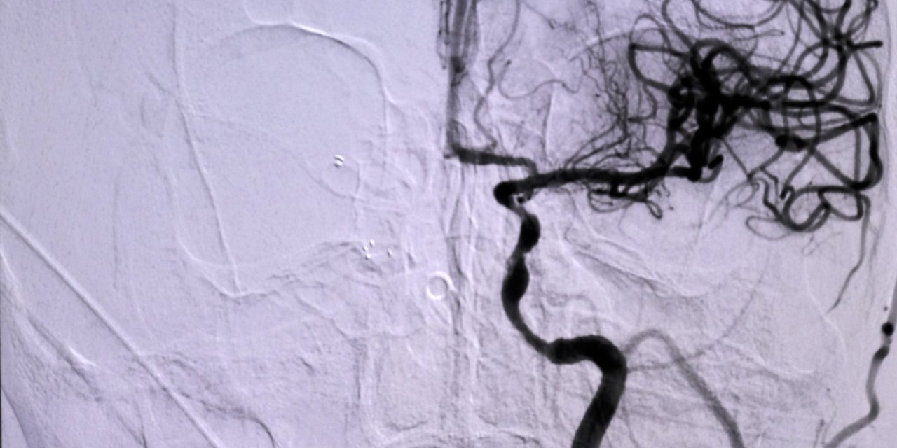 İnmede Erken Müdahale Hayat Kurtarıyor