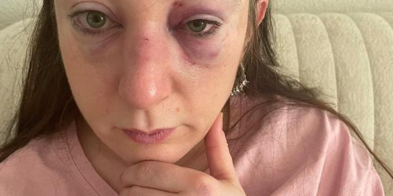 Her Kafa Darbesine 1 Yıl Hapis Talebi - Yeniden