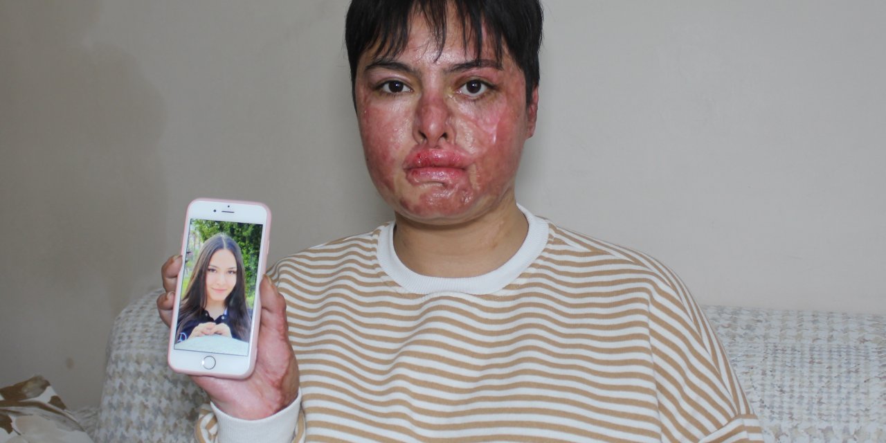 İş Kazası Nedeniyle Vücudunun Yüzde 80'i Yanan Beyzanur: Eski Ben Değilim Artık