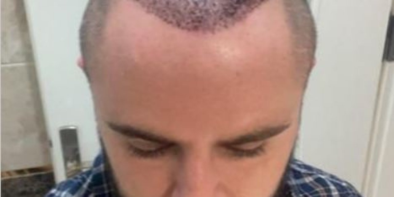 Mahkeme Avukata Yapılan Saç Ekimini Ayıplı İşlem Olarak Kabul Etti; Ücret İadesine Karar Verdi