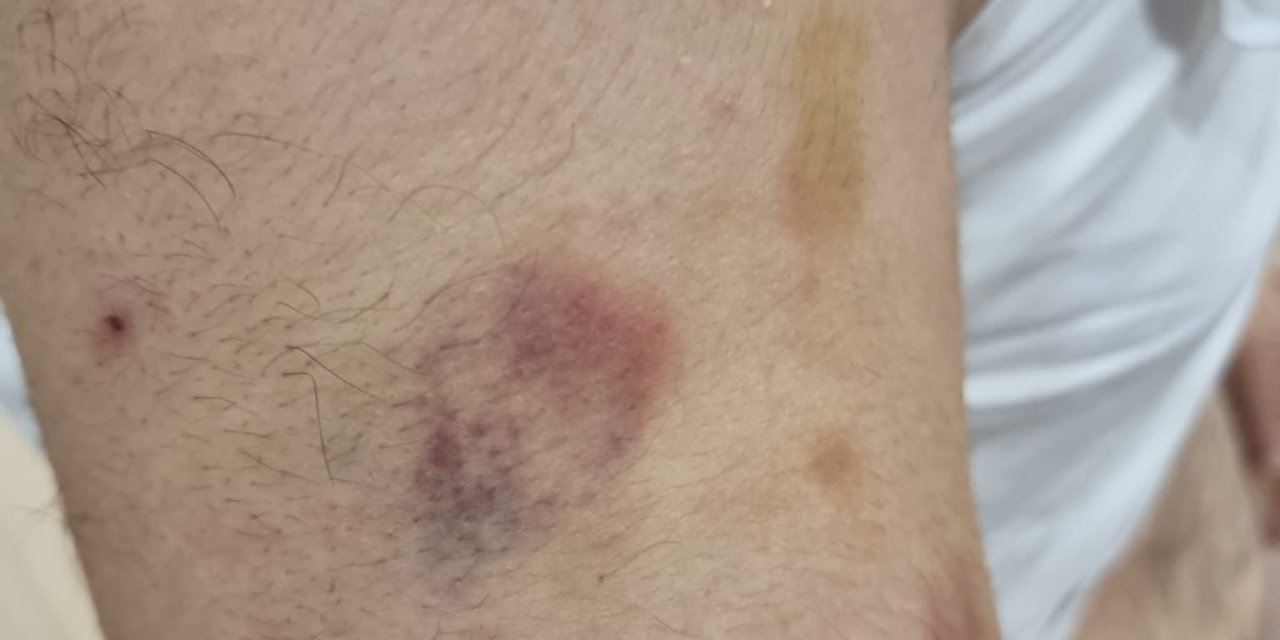 Büyükçekmece'de 'Otizmli Öğrenciyi Öğretmeni Darbetti' İddiası