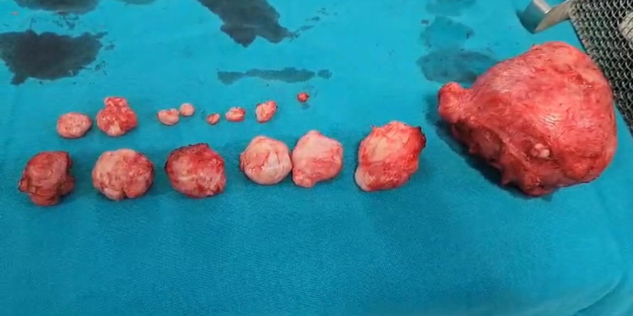 Rahminden 16 tümör çıkarıldı