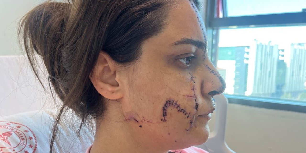 İstanbul -  Marmaray İstasyonu'nda Saldırıya Uğrayan Kadın Yüzündeki 40 Dikişle Dehşet Dolu Anları Anlattı