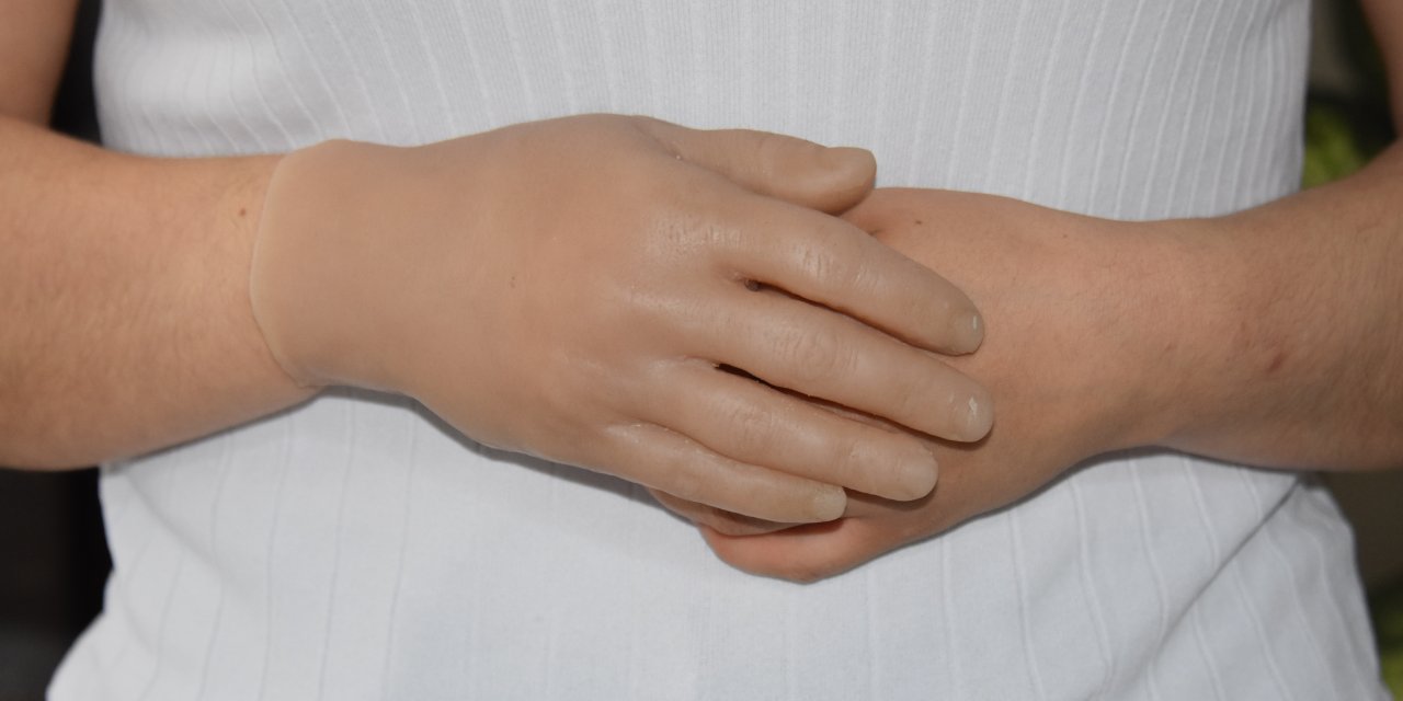 3 Çocuk Annesi Protez Eline Kavuştu