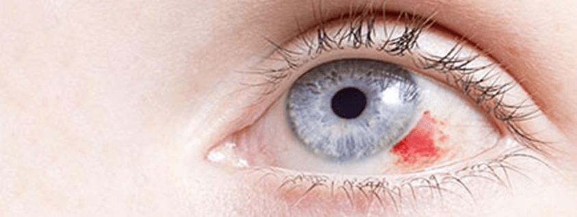 Göz tansiyonuna ilişkin "hafife alınmamalı" uyarısı