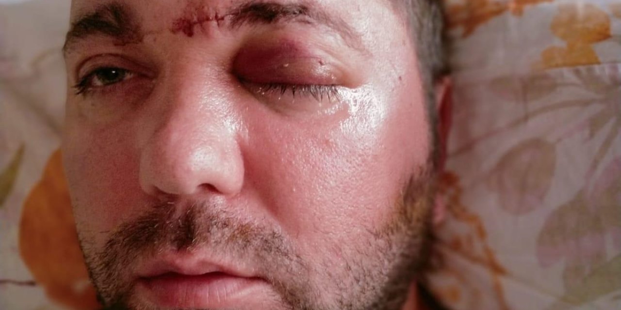 Diş İmplantı, Çene Kemiği İle 'orbita Tabanı'nı Delip, Beyin Omurilik Sıvısına Girdi