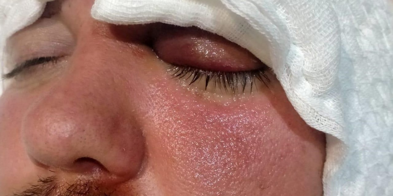 Diş İmplantı, Çene Kemiği İle 'orbita Tabanı'nı Delip, Beyin Omurilik Sıvısına Girdi (2)