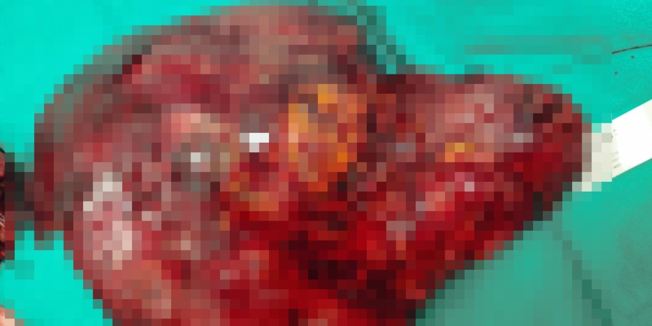 10 Yıldır Karın Ağrısı Çeken Kadının Böbreğinden 3 Kiloluk Tümör Çıkarıldı