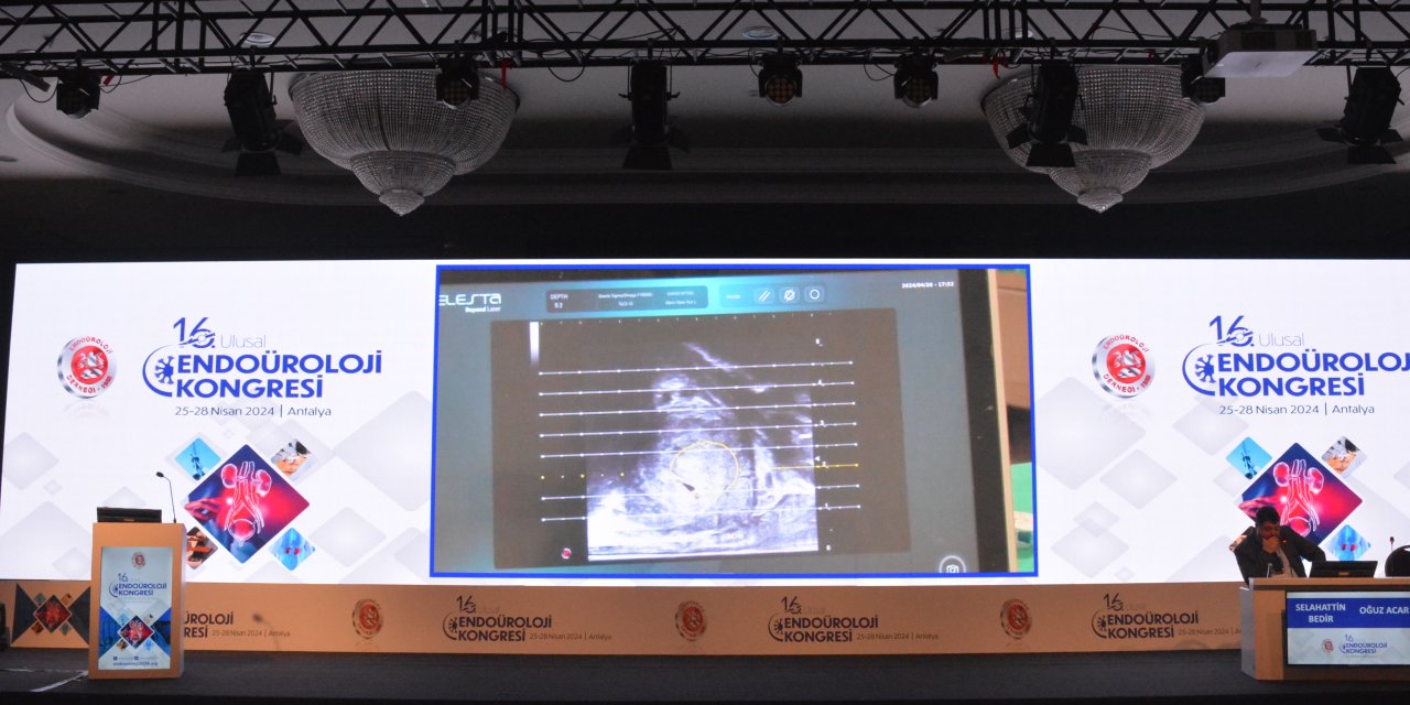 Lazerle Prostat Tümöründen Kurtulan Hastalar Aynı Gün Sosyal Hayatına Dönebiliyor