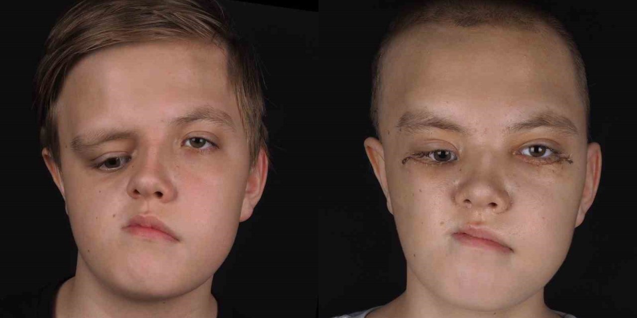 Kazakistanlı 14 Yaşındaki Nikita Şifayı Pendik’te Buldu