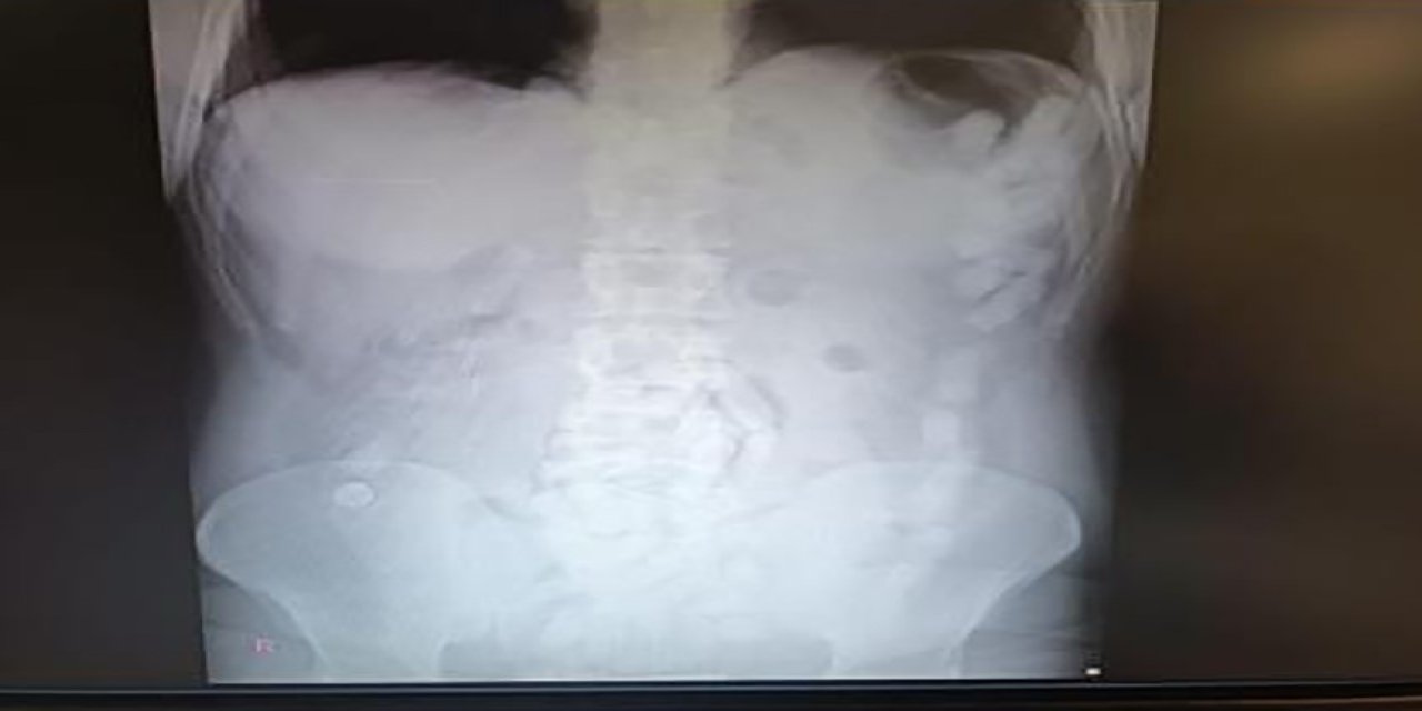 Midesinden 100 Kapsül Uyuşturucu Çıktı