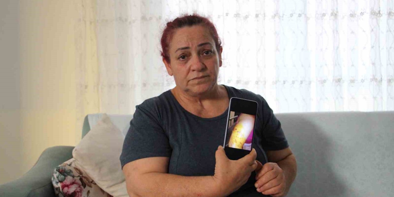 Köpek Saldırısında Yaşadığı Dehşet Anlarını Unutamayan Kadın Tek Başına Sokağa Çıkamıyor