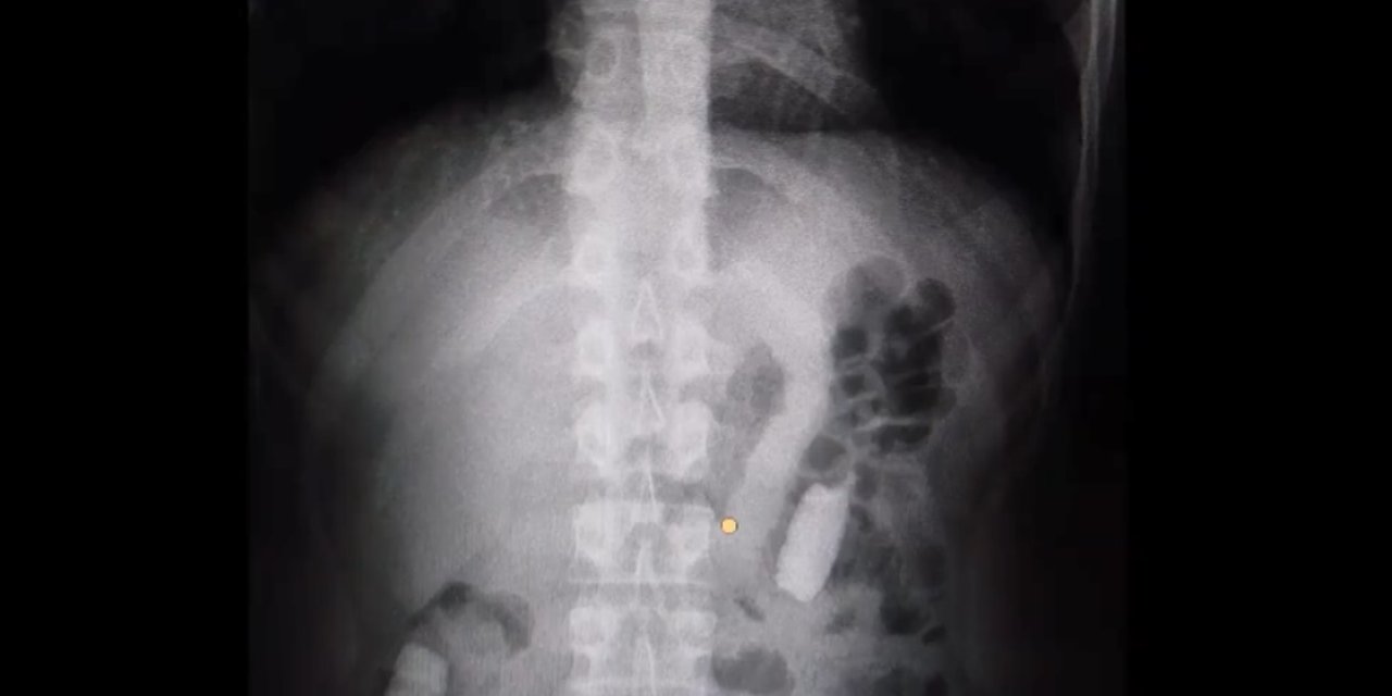 Midesinde Taşıdığı 1 Kilo Uyuşturucuyla Yakalandı