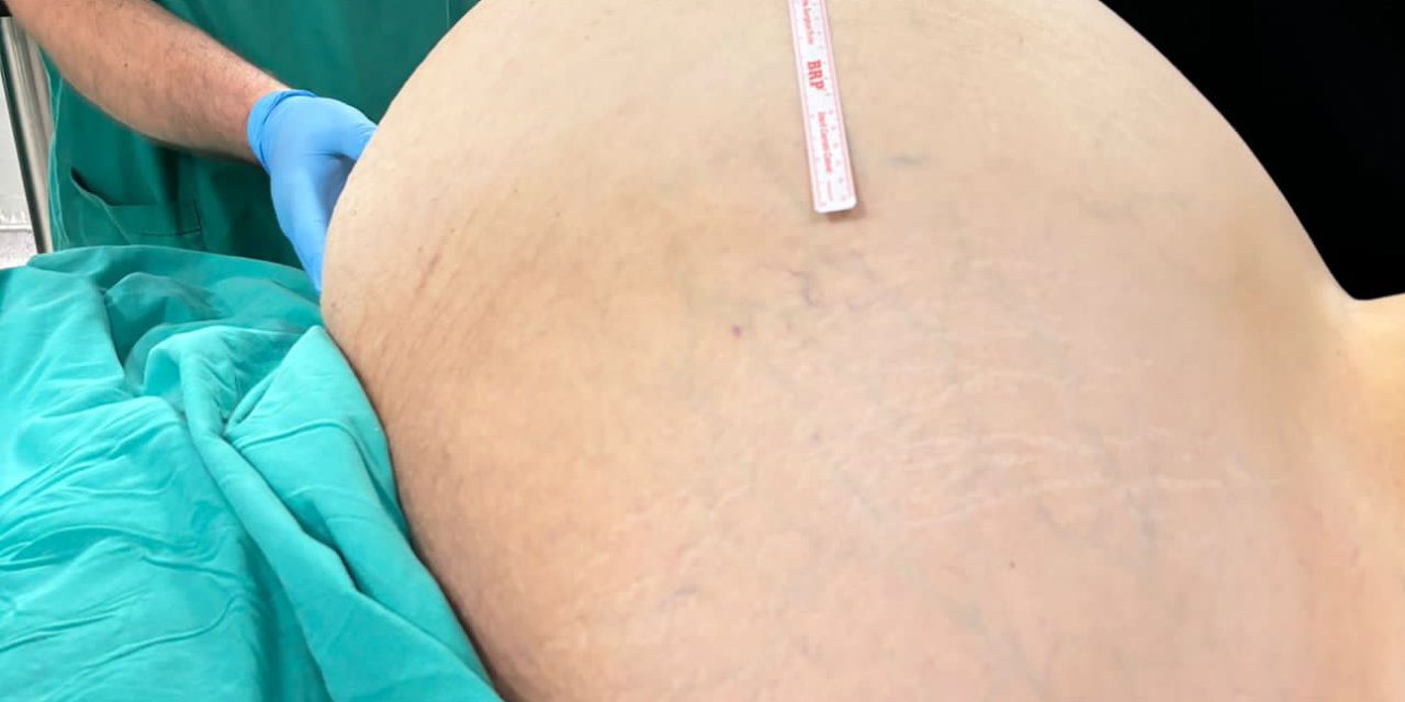 İstanbul - Yumurtalıklarındaki 23 Kiloluk Kitle Operasyonla Çıkarıldı; Doktorlar Da Şaşırdı