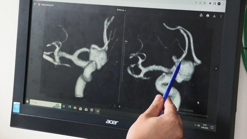 Ölümcül Beyin Anevrizmasıyla İlgili Yeni Keşif