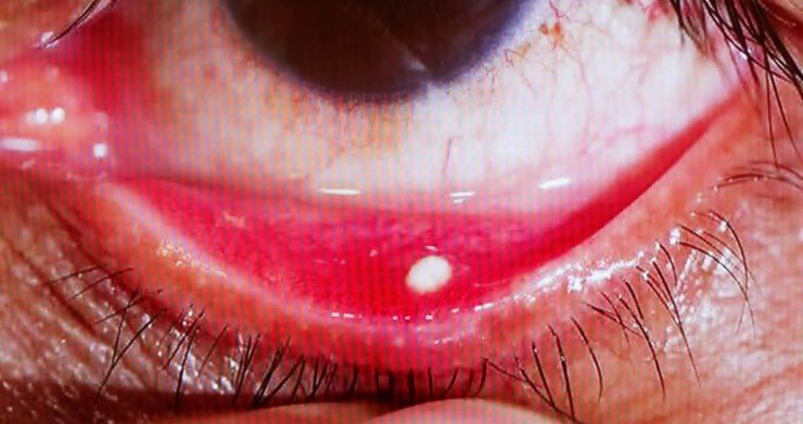 Gözünüzde Batma Varsa Dikkat: Göz Taşınız Olabilir