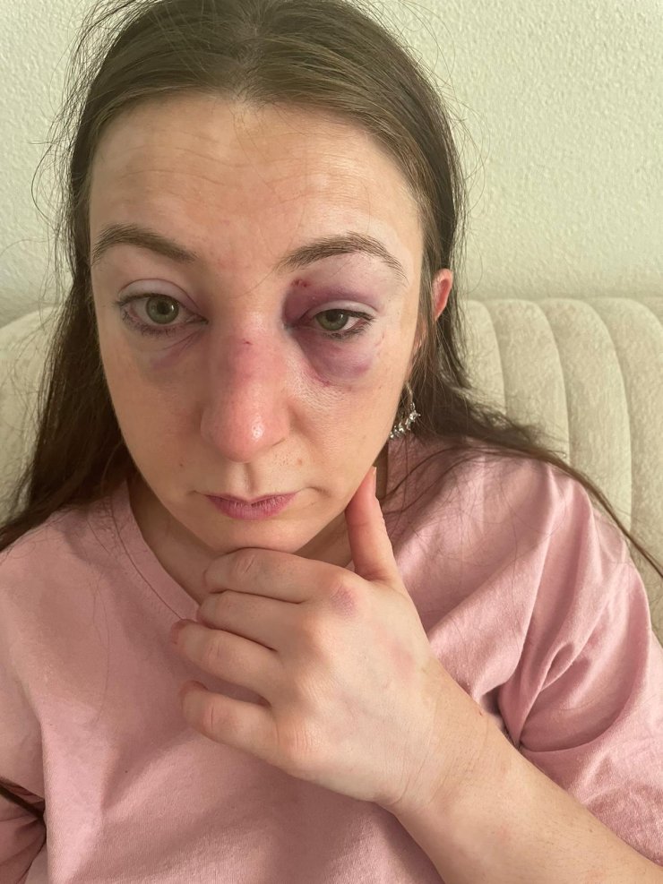 Eski Sevgilisi Tarafından Darbedilen Sibel: 9 Defa Yüzüme Kafa Attı