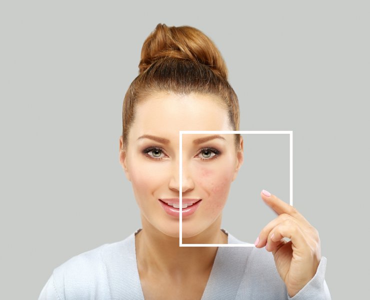 "Rosacea, Kişiye Özel Uygulanacak Doğru Tedavilerle Kontrol Altına Alınabilir"