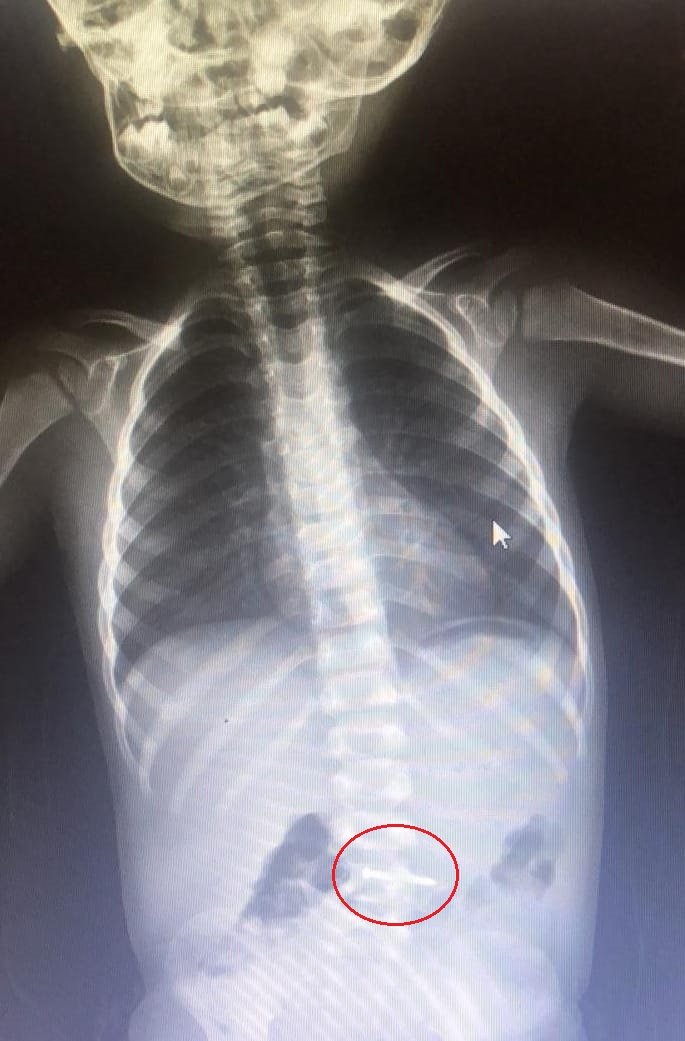 2 Yaşındaki Asil, Oyun Oynarken Yerde Bulduğu Çiviyi Yuttu