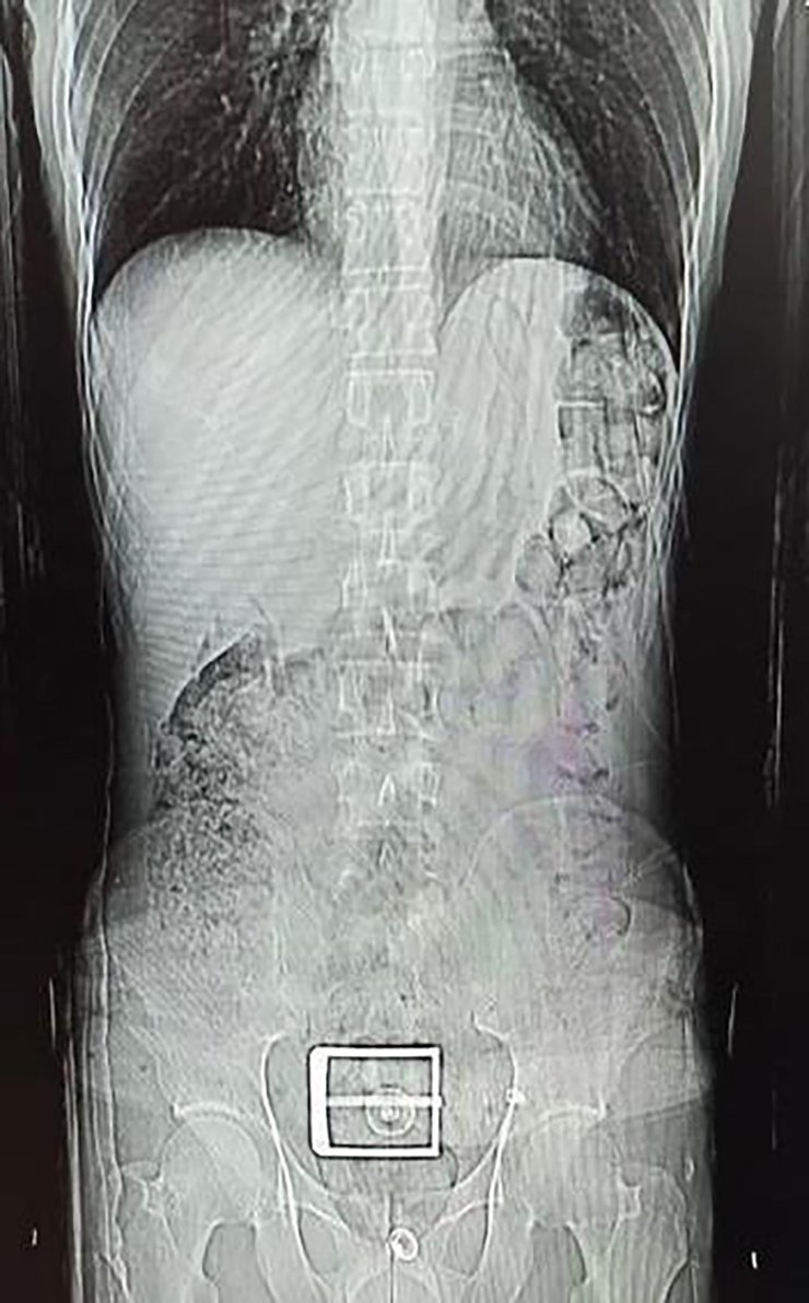 İranlı Şüphelinin Mide Ve Bağırsağından Uyuşturucu Çıktı