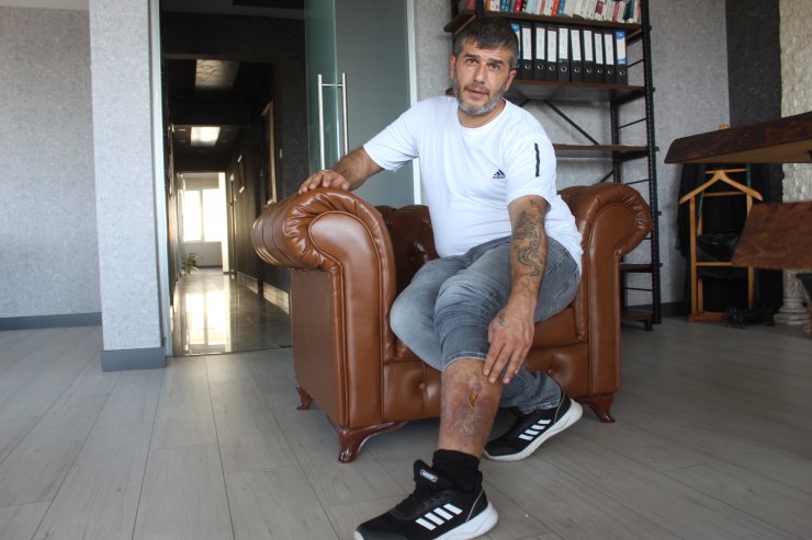 Bacağında Unutulan Bez Parçasıyla 16 Yıl Yaşadı