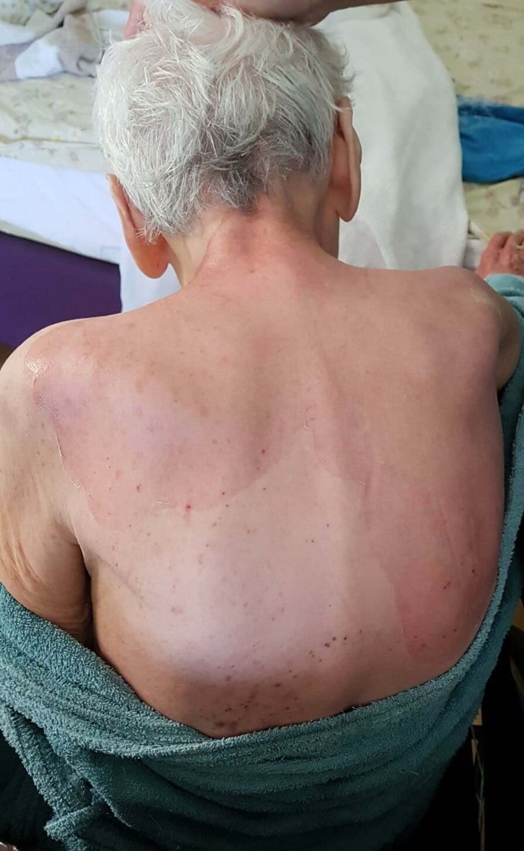 Huzurevindeki Ölümde Beklenen Rapor Geldi: Dermatolojik Hastalık Tespit Edilmedi