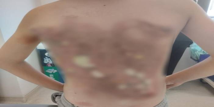 Arnavutköy'de akran zorbalığı iddiası: 12 yaşındaki çocuğun sırtını kolonya ile yaktılar